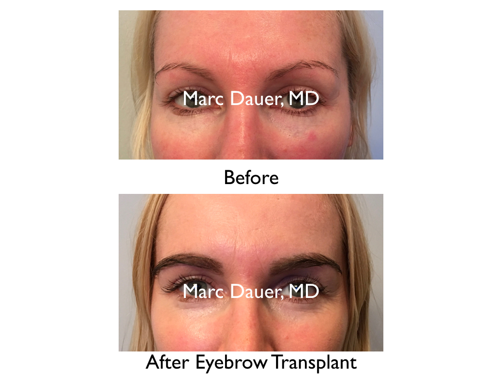 Eyebrow Transplant Surgeon Los Angeles Marc Dauer MD