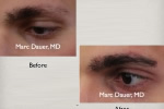 Eyebrow Transplantation For Men