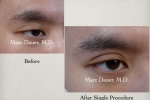 Eyebrow Transplant - Men