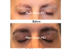 FUE Eyebrow Transplantation For Men