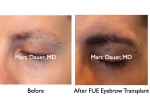 FUE Eyebrow Transplantation For Men