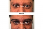 eyebrow transplant before and after photos