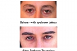 Eyebrow Transplantation For Men