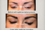 Eyebrow Transplantation