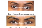 Eyebrow Transplants - Women