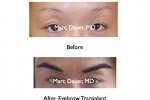 amazing eyebrow transplant photos