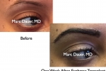Eyebrow Transplants - Women