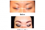 Eyebrow Transplant for Women