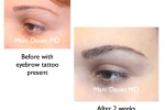 Eyebrow Transplants Images of Women