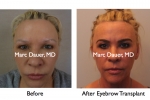 Eyelash and eyebrow implants 