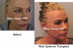 Eyebrow Transplant, Restoration, Enhancement,